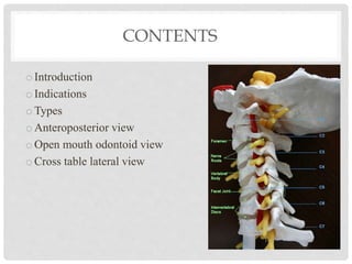 Cervical Spine Radiograph - MaxilloFacial Trauma | PPT