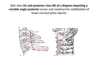 Spine Rod Position Cervical spine injuries - Upper nd Lower | PPTX