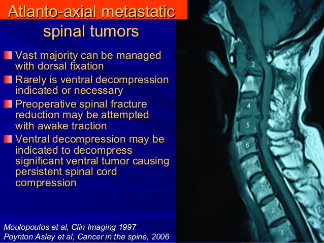 Cervical spine thesis 03 picture