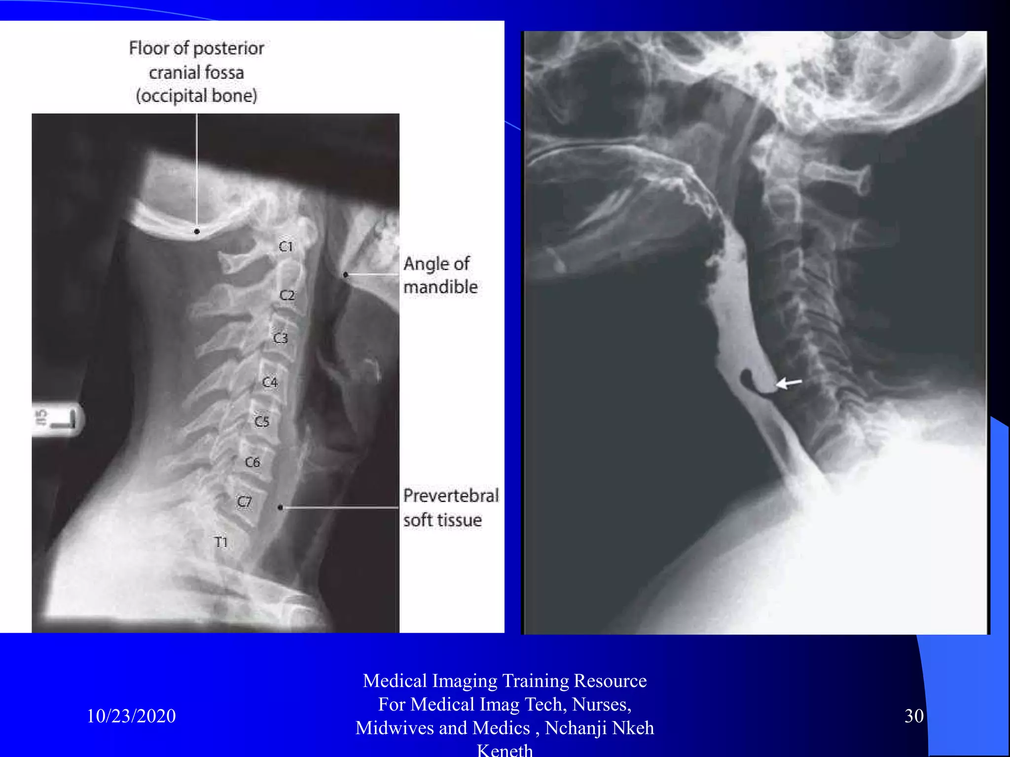 Cervical spine x ray and pathologies radiology training resource ...
