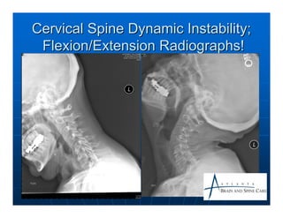 Cervical spondylosis | PDF
