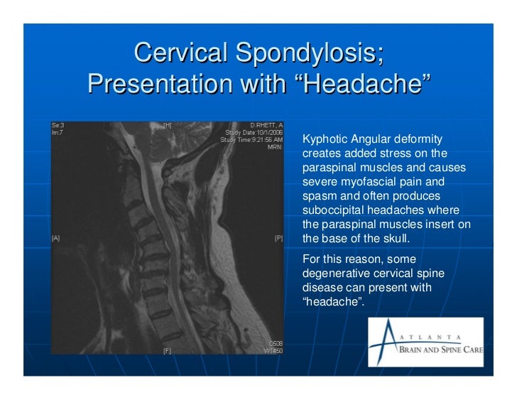 Cervical spondylosis