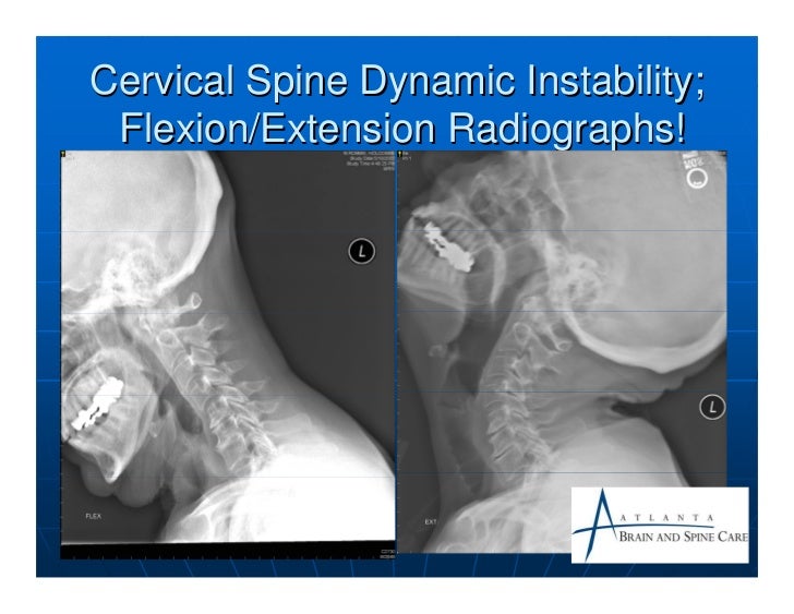 Cervical spondylosis