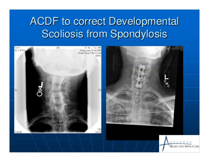 Cervical spondylosis