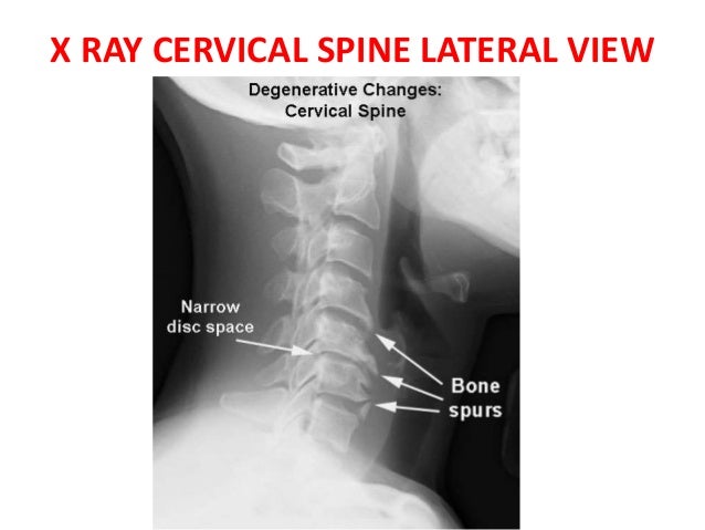 Cervical spondylosis