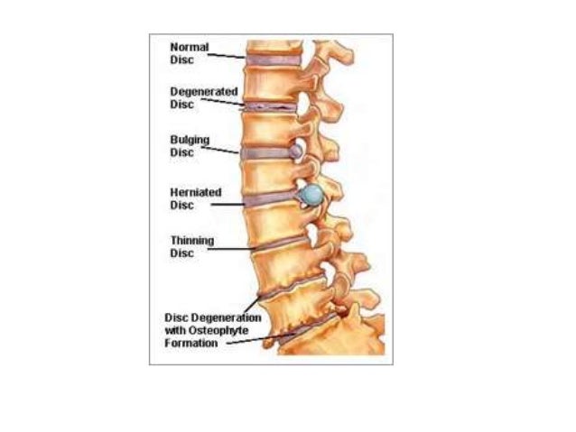 cervical spondylosis