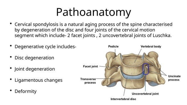 Cervical spondylosis and cervical radiculopathy | PPT
