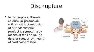 Cervical spondylosis and cervical radiculopathy | PPTX