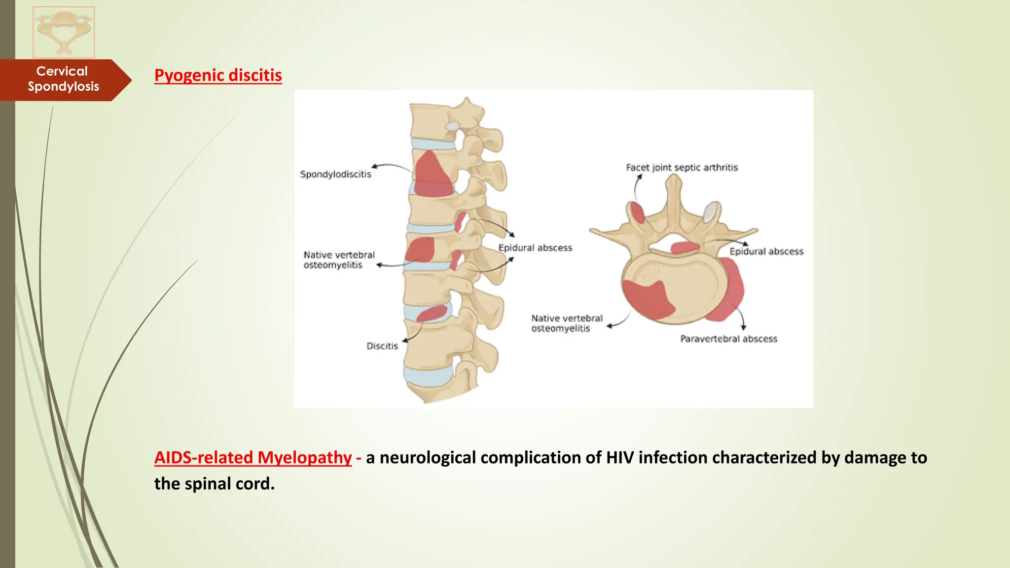 Cervical Spondylosis - An Overview of Degenerative Cervical Spine ...