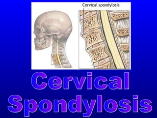 Cervical Spondylosis 