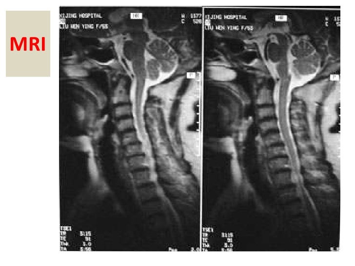 Cervical Spondylosis Syndrome