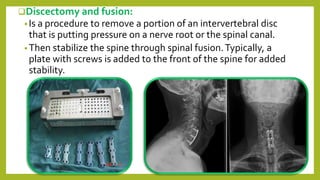 Discectomy and fusion:
•Is a procedure to remove a portion of an intervertebral disc
that is putting pressure on a nerve root or the spinal canal.
•Then stabilize the spine through spinal fusion.Typically, a
plate with screws is added to the front of the spine for added
stability.
 