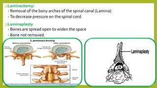 Laminectomy:
• Removal of the bony arches of the spinal canal (Lamina)
• To decrease pressure on the spinal cord
Laminoplasty:
• Bones are spread open to widen the space
• Bone not removed.
 