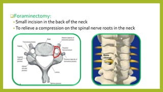 Foraminectomy:
• Small incision in the back of the neck
• To relieve a compression on the spinal nerve roots in the neck
 