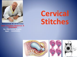 Cervical
StitchesMuhammad M Al Hennawy
Senior Consultant Obstetrician &
Gynacologist
Ras ElBar Central Hospital ,
Egypt 01222503011
 