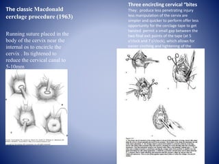 The classic Macdonald
cerclage procedure (1963)
Running suture placed in the
body of the cervix near the
internal os to encircle the
cervix . Its tightened to
reduce the cervical canal to
5-10mm
Three encircling cervical “bites
They: produce less penetrating injury
less manipulation of the cervix are
simpler and quicker to perform offer less
opportunity for the cerclage tape to get
twisted permit a small gap between the
two final exit points of the tape (at 5
o’clock and 7 o’clock), which allows for
easier cinching and tightening of the
cerclage
 
