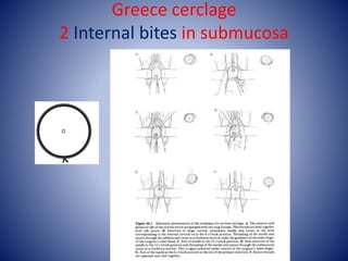 Greece cerclage
2 Internal bites in submucosa
 