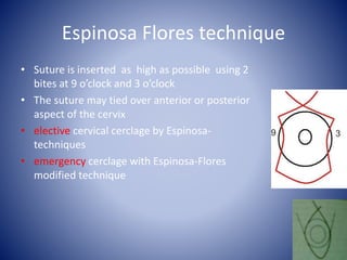Espinosa Flores technique
• Suture is inserted as high as possible using 2
bites at 9 o’clock and 3 o’clock
• The suture may tied over anterior or posterior
aspect of the cervix
• elective cervical cerclage by Espinosa-
techniques
• emergency cerclage with Espinosa-Flores
modified technique
 