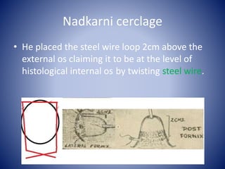 Nadkarni cerclage
• He placed the steel wire loop 2cm above the
external os claiming it to be at the level of
histological internal os by twisting steel wire.
 