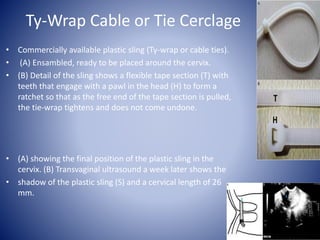 Ty-Wrap Cable or Tie Cerclage
• Commercially available plastic sling (Ty-wrap or cable ties).
• (A) Ensambled, ready to be placed around the cervix.
• (B) Detail of the sling shows a flexible tape section (T) with
teeth that engage with a pawl in the head (H) to form a
ratchet so that as the free end of the tape section is pulled,
the tie-wrap tightens and does not come undone.
• (A) showing the final position of the plastic sling in the
cervix. (B) Transvaginal ultrasound a week later shows the
• shadow of the plastic sling (S) and a cervical length of 26
mm.
 