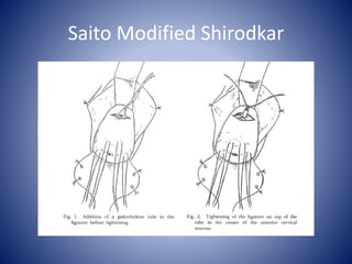 Saito Modified Shirodkar
 