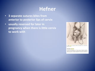 Hefner
• 3 separate sutures bites from
anterior to posterior lips of cervix
• usually reserved for later in
pregnancy when there is little cervix
to work with
 