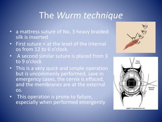 The Wurm technique
• a mattress suture of No. 3 heavy braided
silk is inserted
• First suture = at the level of the internal
os from 12 to 6 o’clock.
• A second similar suture is placed from 3
to 9 o’clock
• This is a very quick and simple operation
but is uncommonly performed, save in
emergency cases, the cervix is effaced,
and the membranes are at the external
os.
• This operation is prone to failure,
especially when performed emergently
 