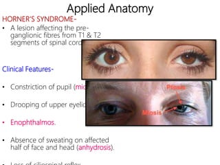 Applied Anatomy
HORNER’S SYNDROME-
• A lesion affecting the pre-
ganglionic fibres from T1 & T2
segments of spinal cord.
Clinical Features-
• Constriction of pupil (miosis).
• Drooping of upper eyelid (ptosis).
• Enophthalmos.
• Absence of sweating on affected
half of face and head (anhydrosis).
 