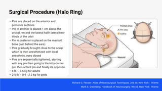 • Pins are placed on the anterior and
posterior sections
• Pin in anterior is placed 1 cm above the
orbital rim and the lateral half/ lateral two-
thirds of the orbit
• Pin in posterior is placed on the mastoid
bone (just behind the ears)
• Pins gradually brought close to the scalp
which is then anesthetized with local
anesthetic, eyes closed
• Pins are sequentially tightened, starting
with any pin then going to the kitty-corner
pin, then a third pin and finally its opposite.
• 8 lb ~ 3.6 kg for adults
• 2-5 lb ~ 0.9 - 2.2 kg for peds
Surgical Procedure (Halo Ring)
Richard G. Fessler. Atlas of Neurosurgical Techniques. 2nd ed. New York : Thieme
Mark S. Greenberg. Handbook of Neurosurgery. 9th ed. New York: Thieme
 