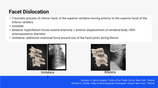 • Traumatic process of inferior facet of the superior vertebra moving anterior to the superior facet of the
inferior vertebra
• Unstable
• Bilateral: hyperflexion forces extend anteriorly + anterior displacement of vertebral body >50%
anterioposterior diameter
• Unilateral: additional rotational force around one of the facet joints during flexion
Facet Dislocation
Vaccaro, A. Spine Surgery: Tricks of the Trade. 3rd ed. New York: Thieme
Richard G. Fessler. Atlas of Neurosurgical Techniques. 2nd ed. New York : Thieme
Unilatera
l
Bilatera
l
 