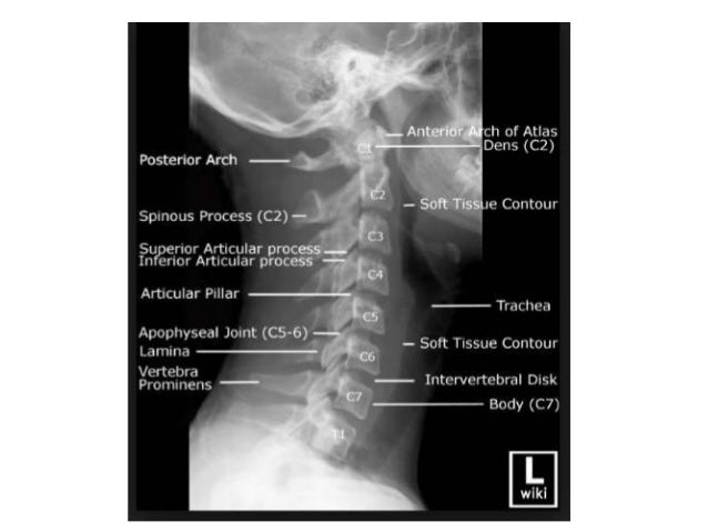 Cervical trauma