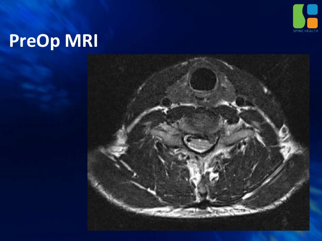Unilateral Biportal Endoscopic Posterior Cervical Laminectomy and Dis…