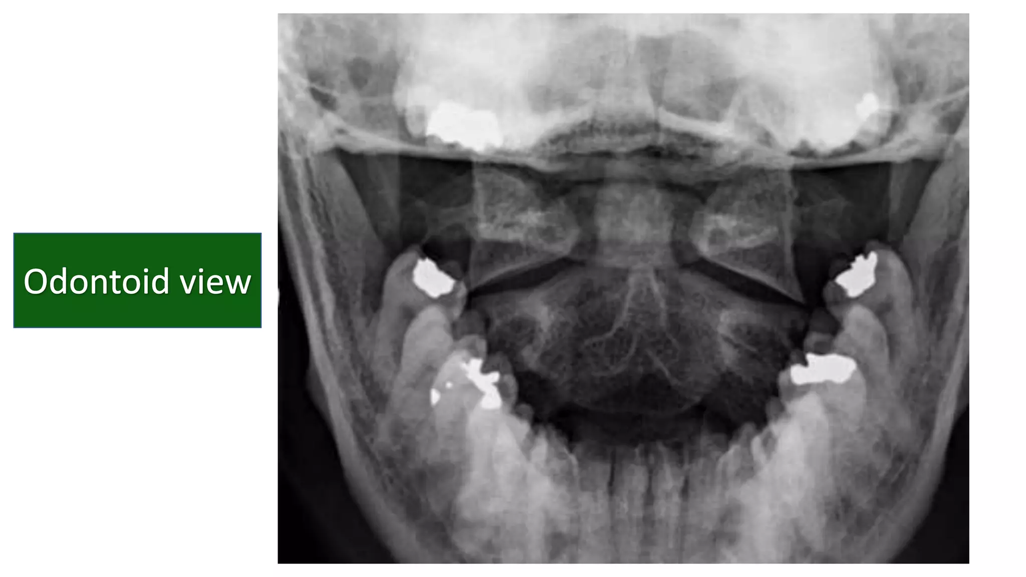 Cervical vertebrae anatomy and pathology | PPTX