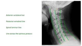 Anterior vertebral line
Posterior vertebral line
Spinal laminar line
Line across the spinous process
 
