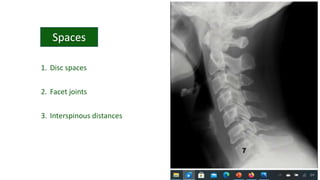 1. Disc spaces
2. Facet joints
3. Interspinous distances
 