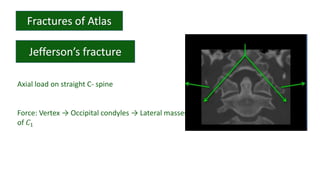 Axial load on straight C- spine
Force: Vertex → Occipital condyles → Lateral masses
of 𝐶1
 