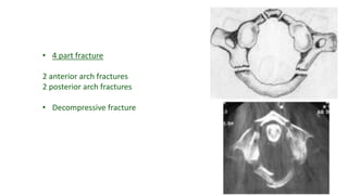• 4 part fracture
2 anterior arch fractures
2 posterior arch fractures
• Decompressive fracture
 