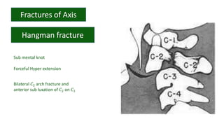 Sub mental knot
Forceful Hyper extension
Bilateral 𝐶2 arch fracture and
anterior sub luxation of 𝐶2 on 𝐶3
 