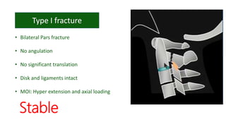 • Bilateral Pars fracture
• No angulation
• No significant translation
• Disk and ligaments intact
• MOI: Hyper extension and axial loading
Stable
 