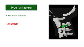 • MOI: Flexion- distraction
Unstable
 