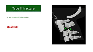 • MOI: Flexion- distraction
Unstable
 