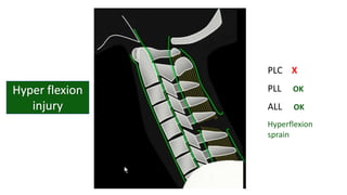 PLC X
PLL OK
ALL OK
Hyperflexion
sprain
 