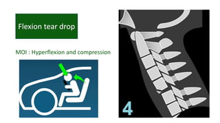 MOI : Hyperflexion and compression
 