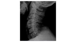 Cervical vertebrae anatomy and pathology