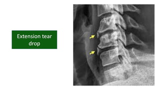 Cervical vertebrae anatomy and pathology