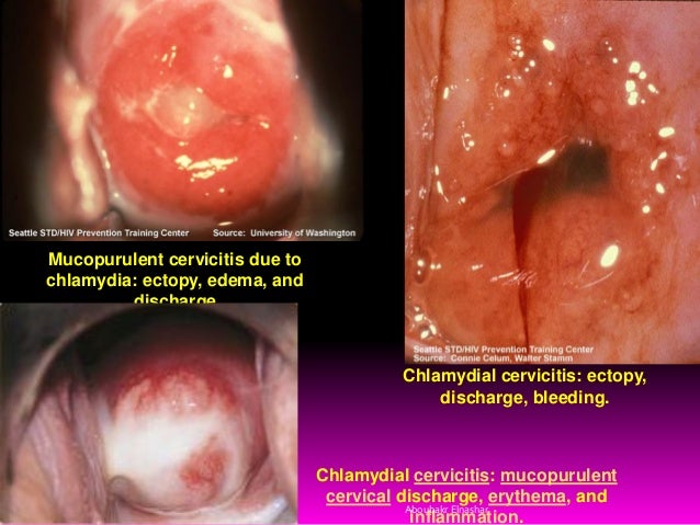 Mucopurulent cervicitis due tochlamydia: ectopy, edema, anddischargeChlamydial cervicitis: mucopurulentcervical discha...