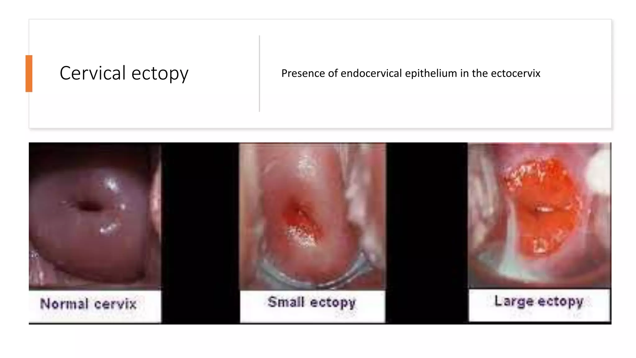 Cervicitis.pptx