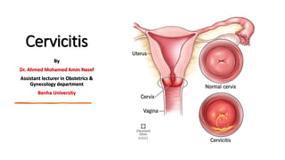 Cervicitis
By
Dr. Ahmed Mohamed Amin Nasef
Assistant lecturer in Obstetrics &
Gynecology department
Benha University
 