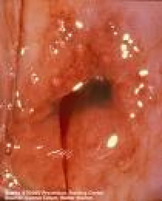 Cervicitis
