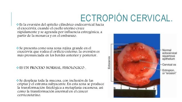 Cervicitis Aguda Y Cr nica Ectropion Cervical Ulceracion Erosion Cervicitis Aguda Y Cr nica Ectropion Cervical Ulceracion Erosion